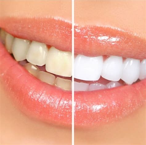 teeth whitening mcallen tx